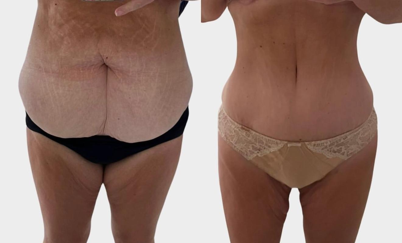 Abdominoplasty before and after result 1