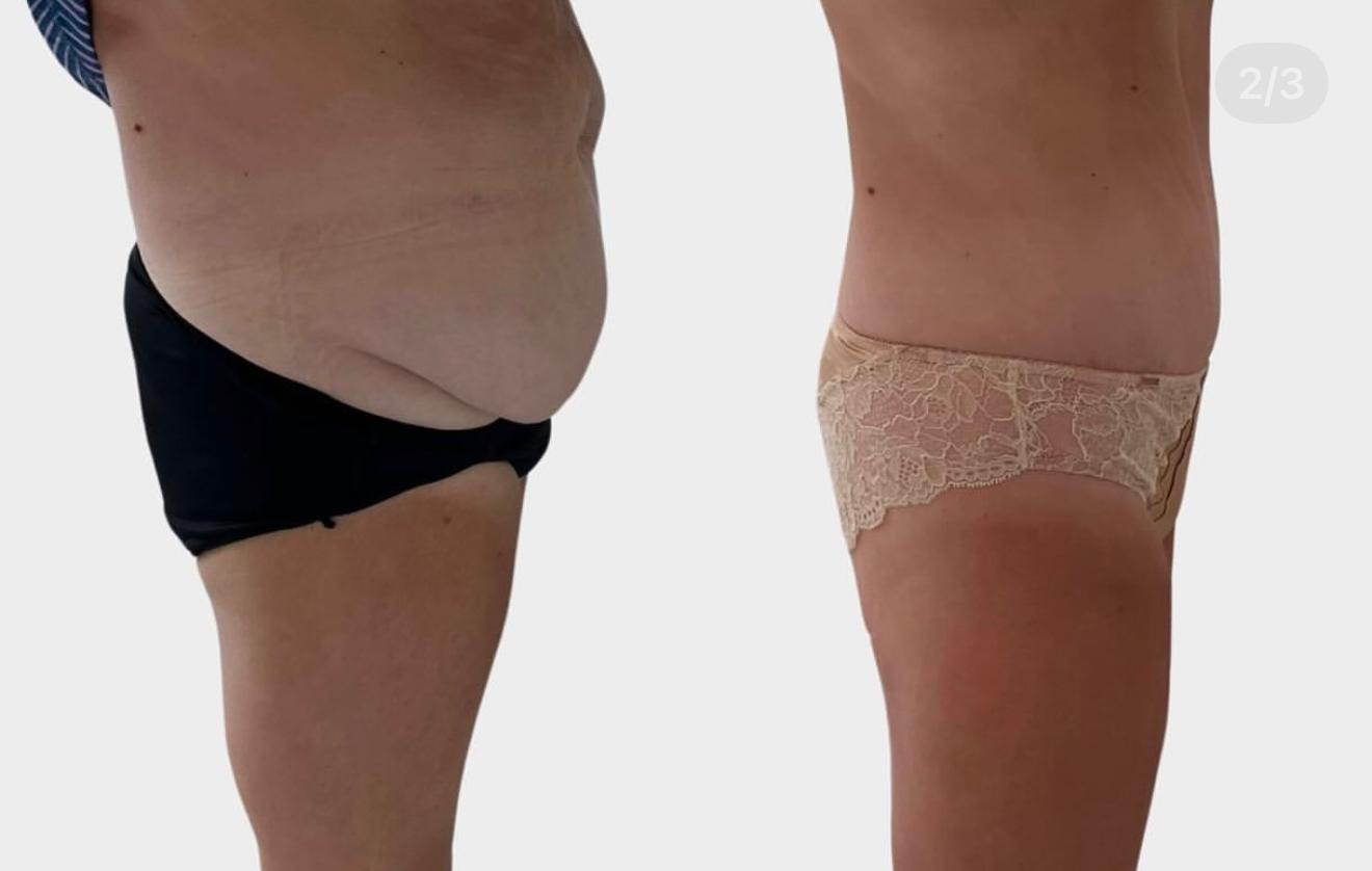 Abdominoplasty before and after result 2