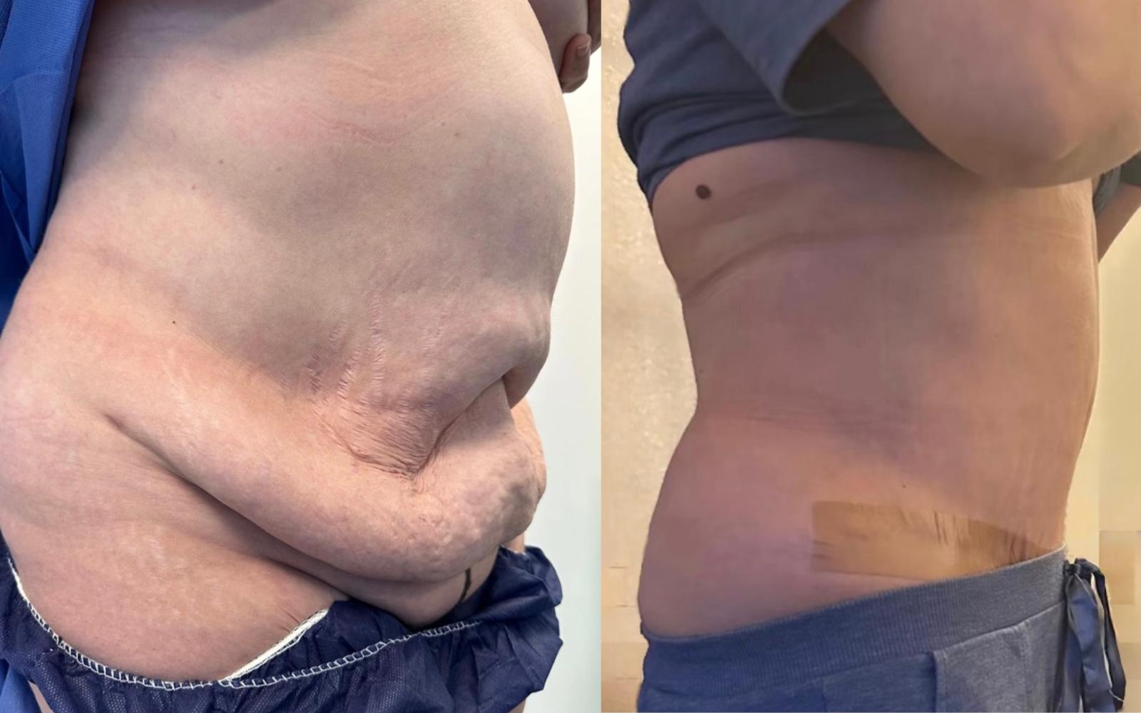 Abdominoplasty before and after result 3