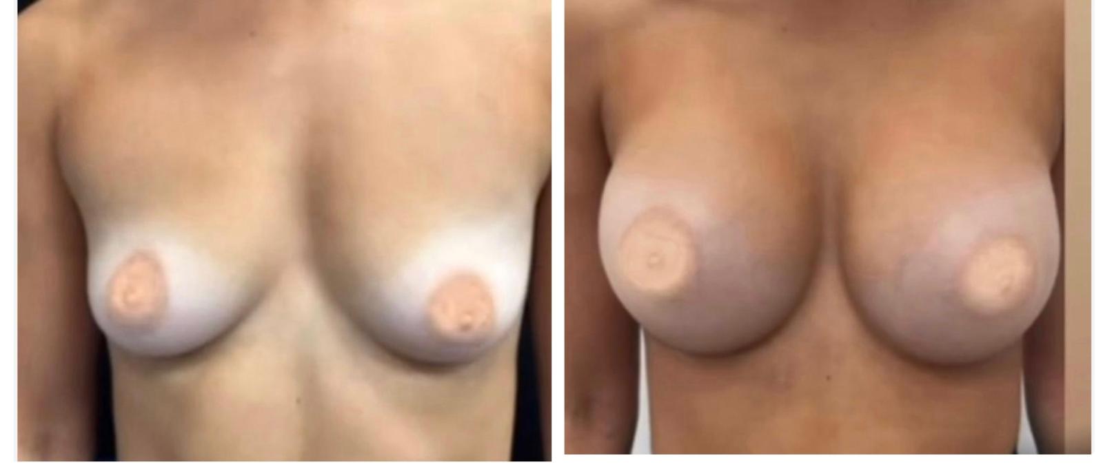 Breast augmentation before and after result 2