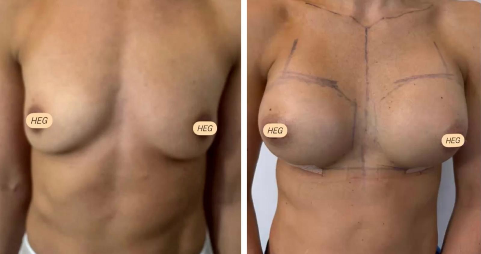 Breast augmentation before and after result 3
