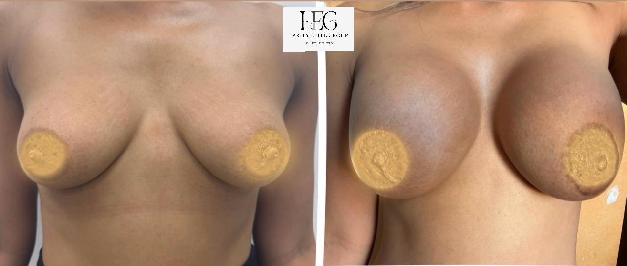 Breast augmentation before and after result 4