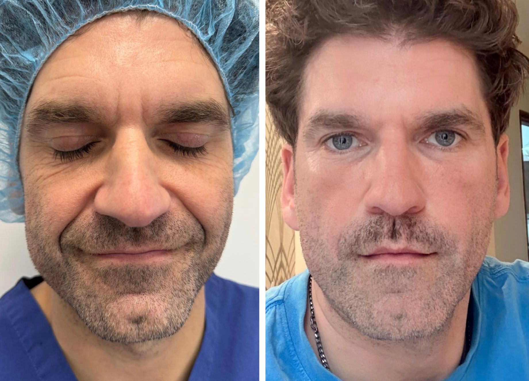 Micro and nano fat transfer before and after result 1