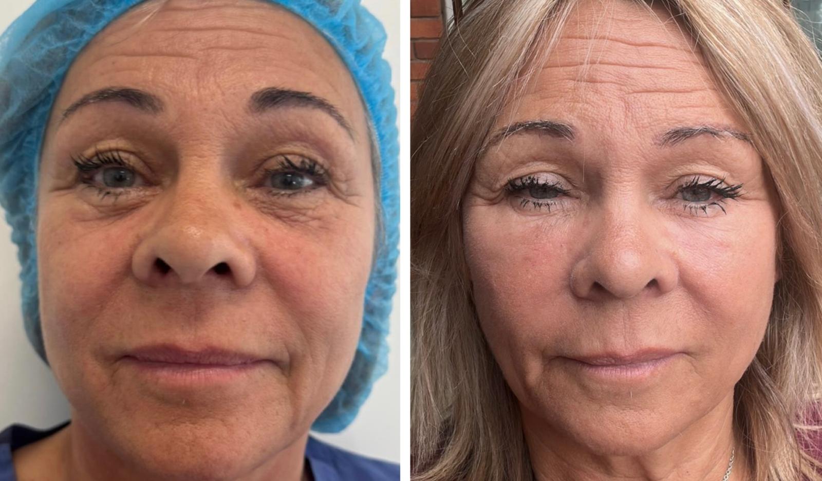 Micro and nano fat transfer before and after result 2
