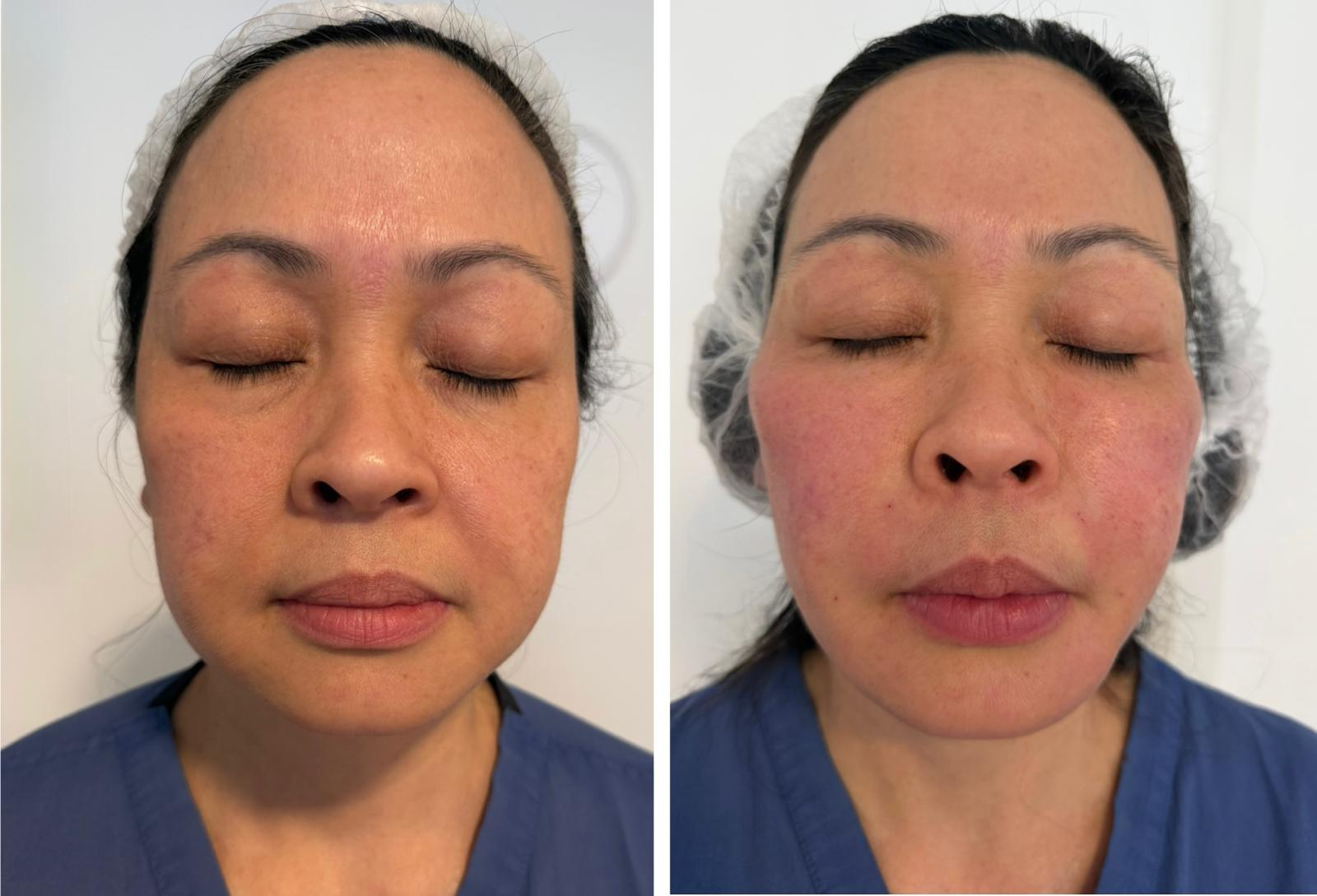 Micro and nano fat transfer before and after result 3