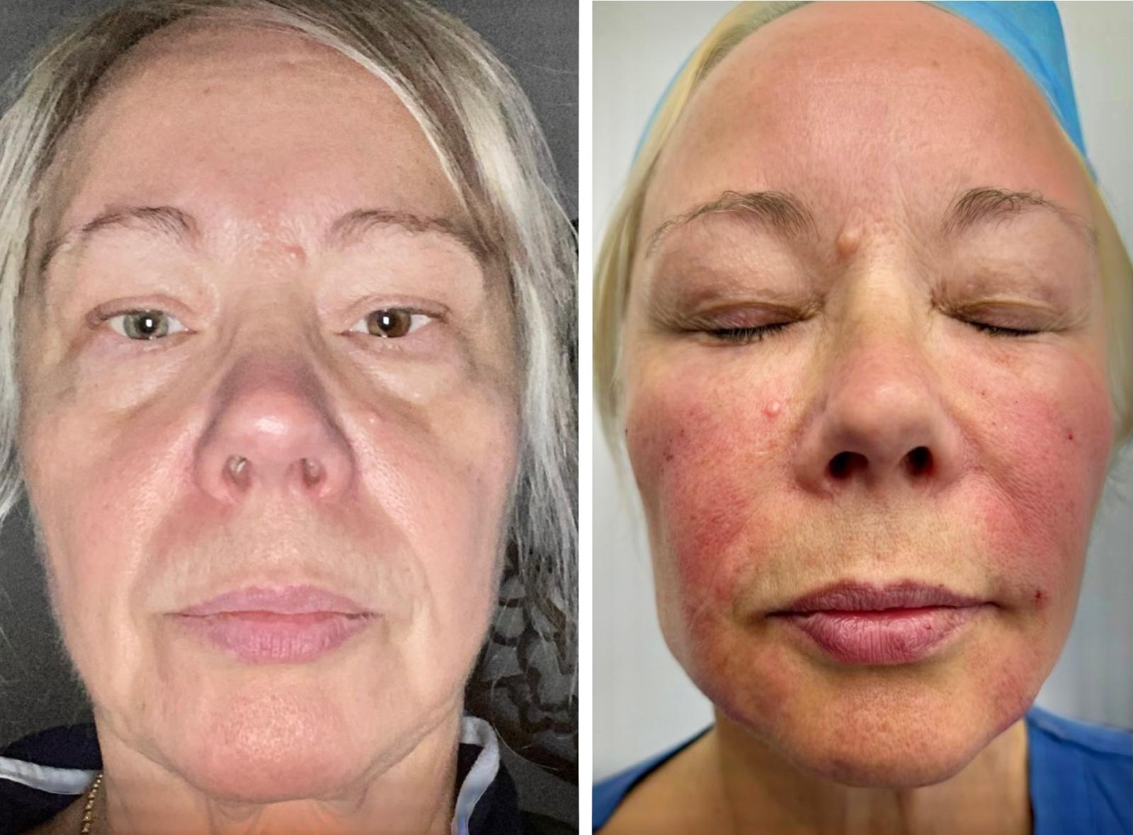 Micro and nano fat transfer before and after result 4