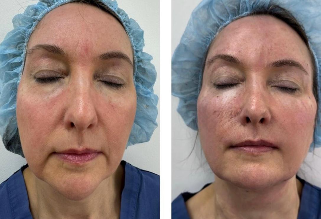 Micro and nano fat transfer before and after result 5