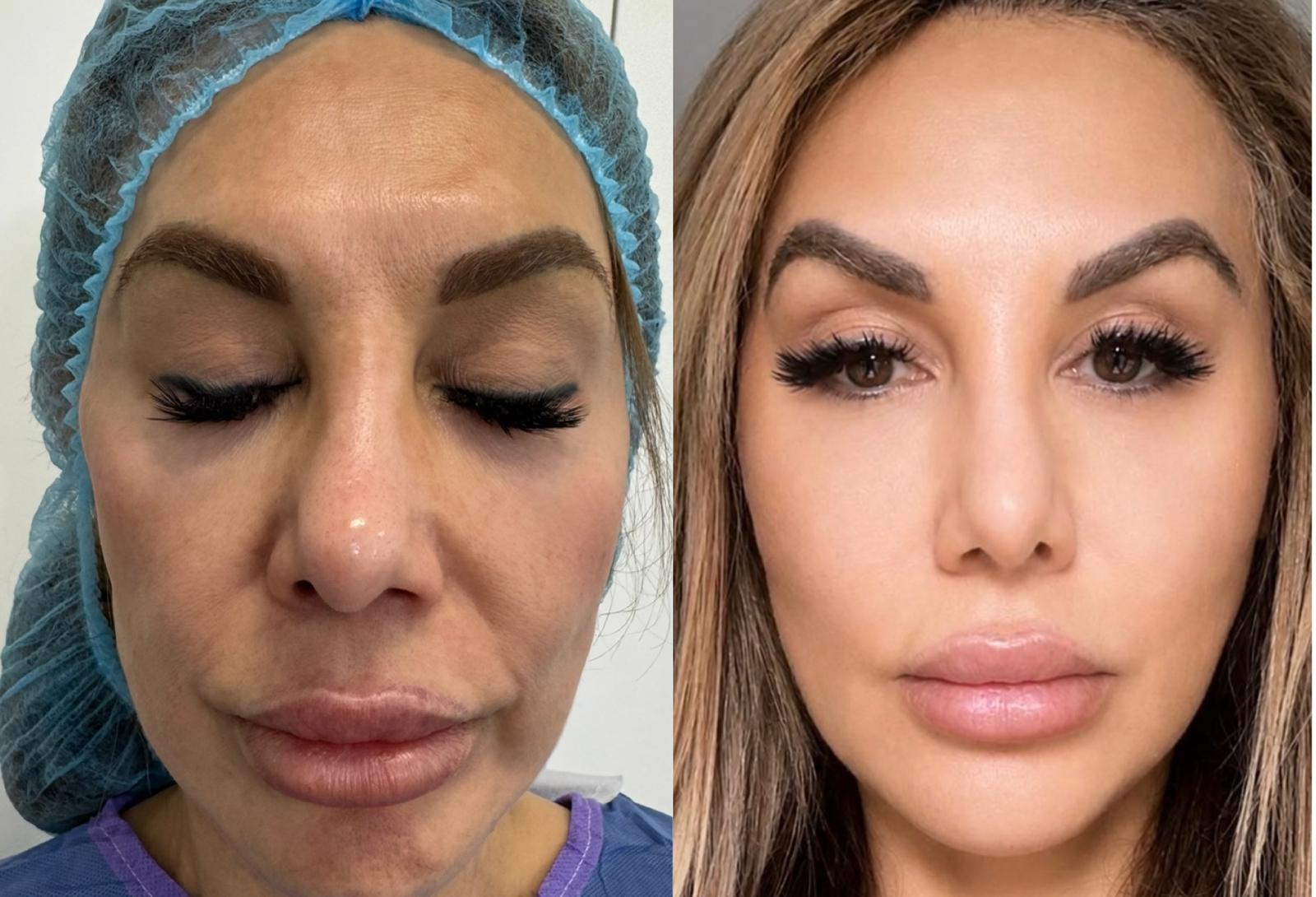 Micro and nano fat transfer before and after result 6
