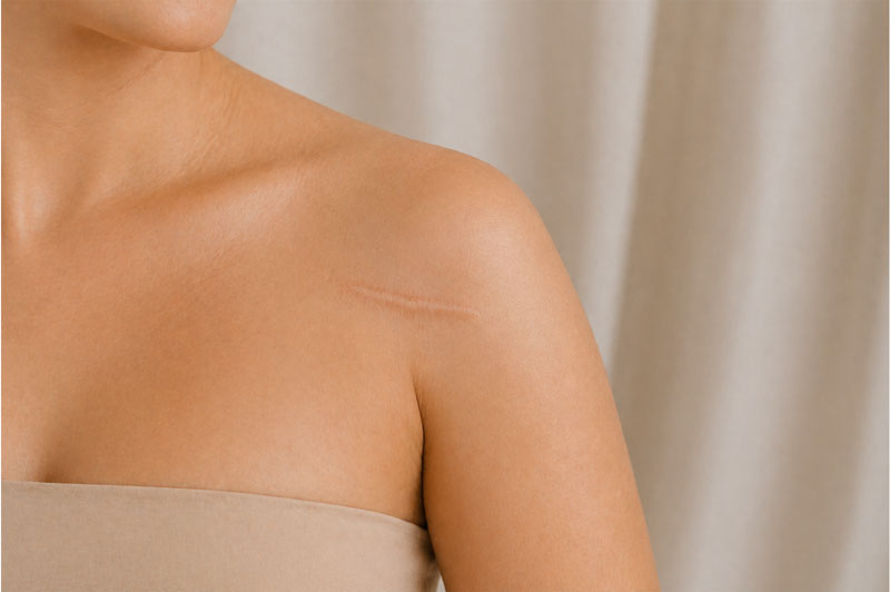 Scar Revision