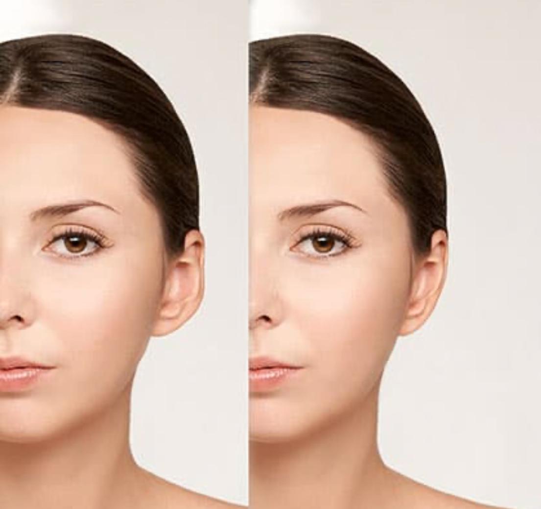 Otoplasty before and after result 1