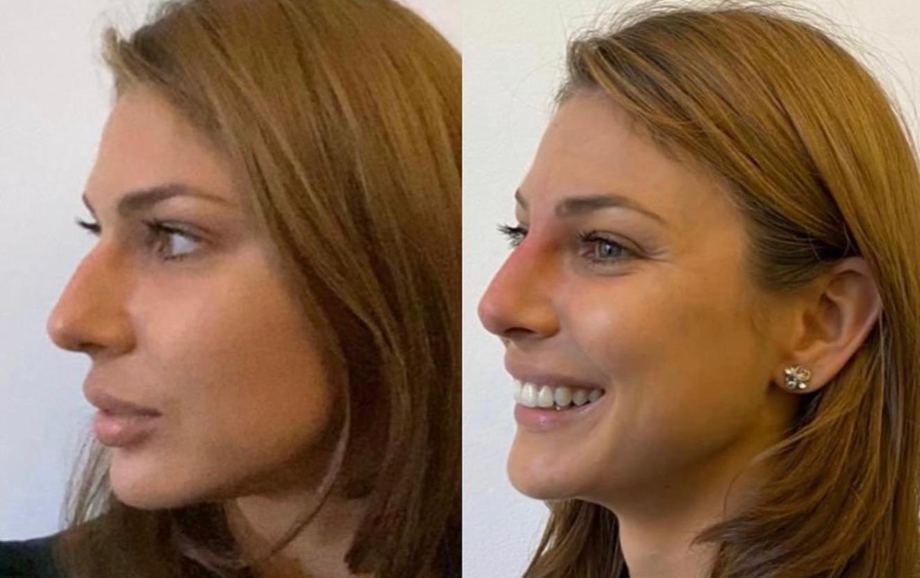 Rhinoplasty before and after result 1