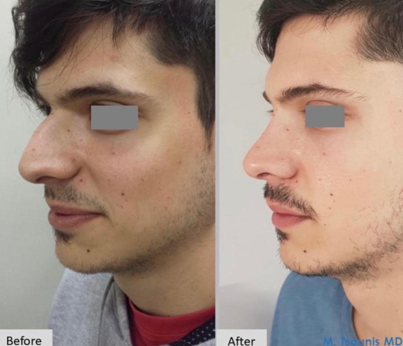 Rhinoplasty before and after result 2