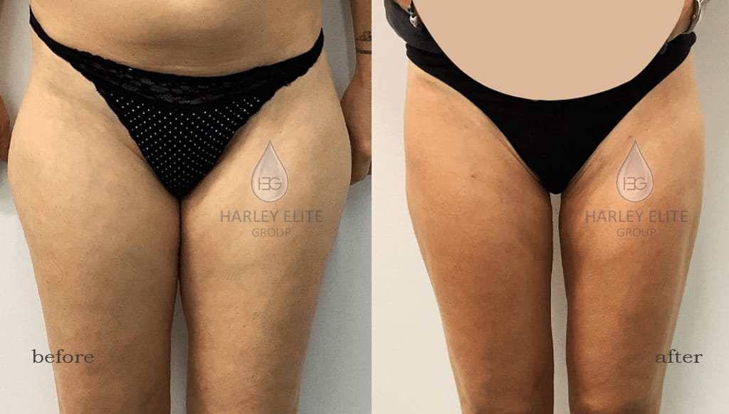 Female-Liposuction-Harley.jpg