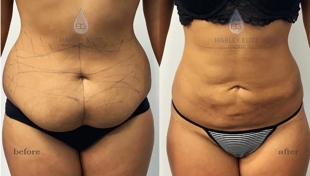 Liposuction-Female-Abdominal.jpg