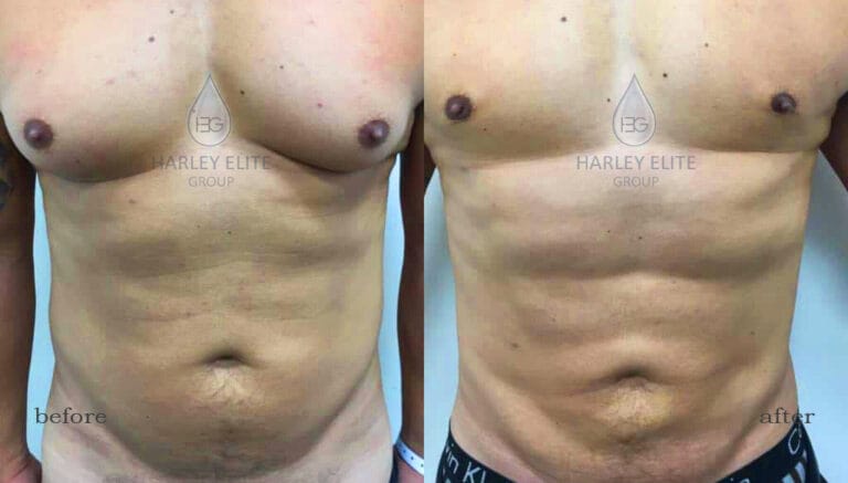 liposuction-heg-male1.jpg