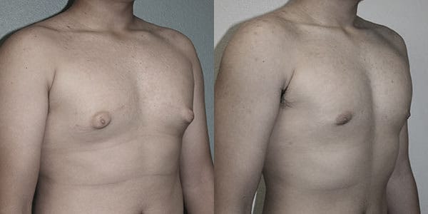 Before_and_After_Male_Breast_Reduction
