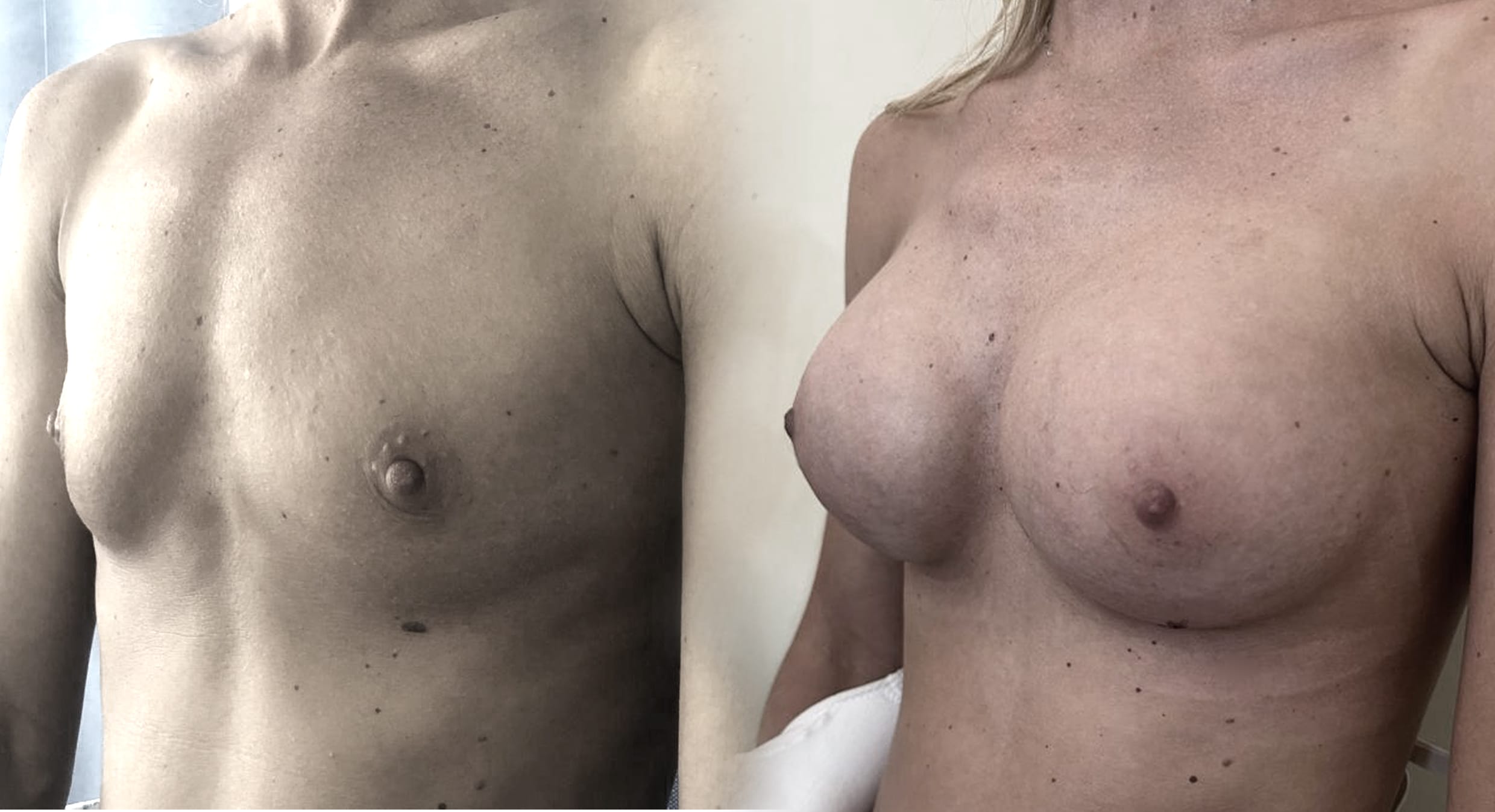 Breast Enhancement1