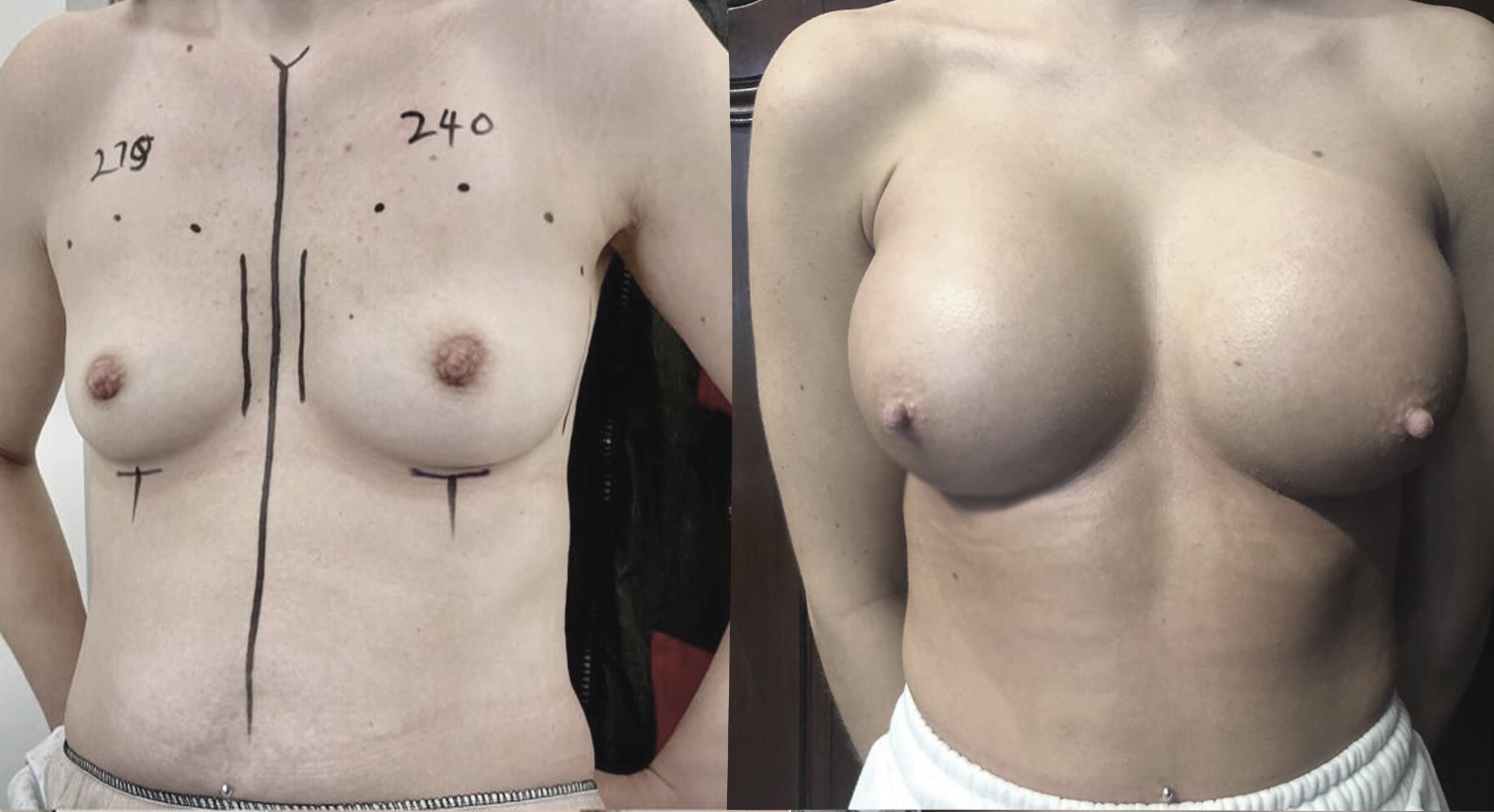 Breast Enhancement4