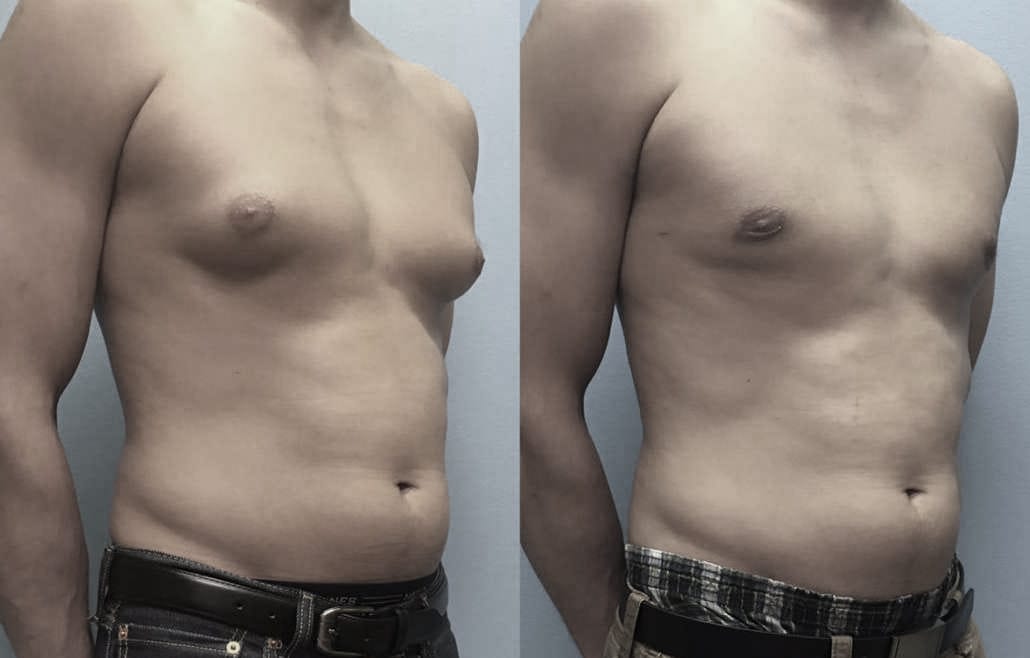 Male-Breast-Reduction