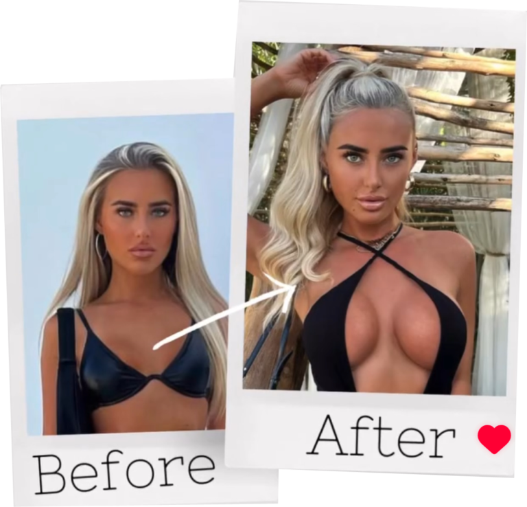 Read more about the article BREAST AUGMENTATION – COSMETIC SURGERY